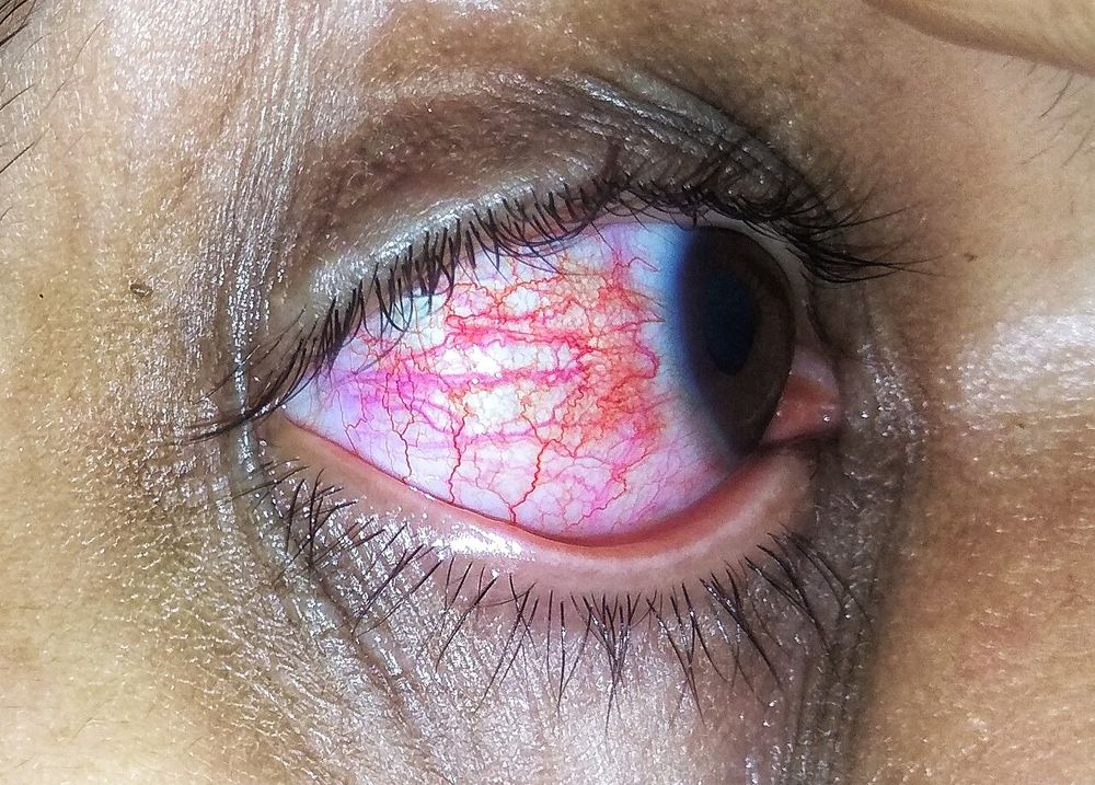 Photo of conjunctivitis (aankh aana): the white of the eye is pink-red with swollen, visible blood vessels