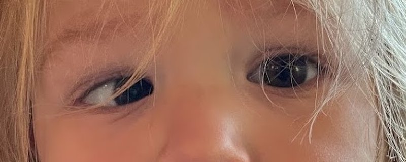 Photo of a young child with squint (strabismus, bhengapan): one eye turns inward towards the nose