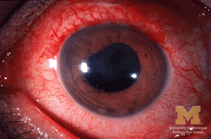 Clinical photo of anterior uveitis (aankh ke andar sujan): deep redness around the coloured part of the eye (ciliary flush)